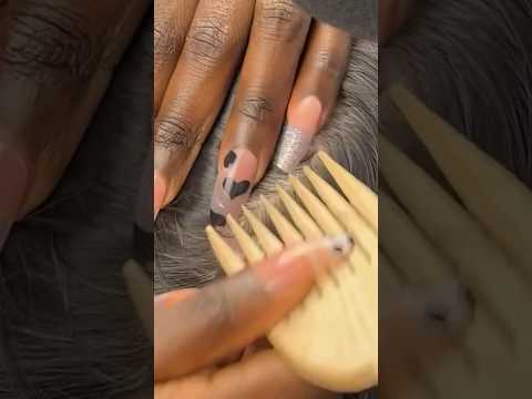 The Most satisfying NITPICKING Scalp WHITEHEADS  #youtubeshorts #shorts #asmr #satisfying