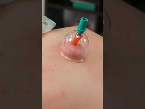 Therapeutic cupping and deep-tissue massage for Evelina #massagetherapy