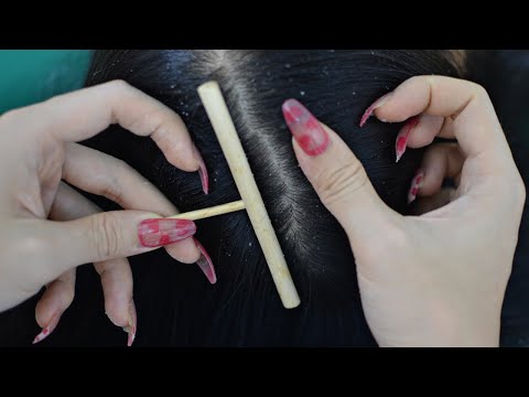 ASMR Scalp Check With Sticks, Scalp Scratching With Long Nails For Relaxation
