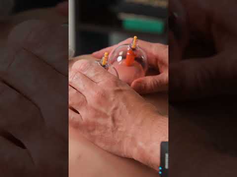 Therapeutic cupping back massage for Evelina in a massage chair #backmassage