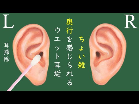 ASMR 耳穴が痒くなる湿った耳垢を綿棒で掃除します。wet earwax｜젖은 귀지｜ขี้หูเปียก