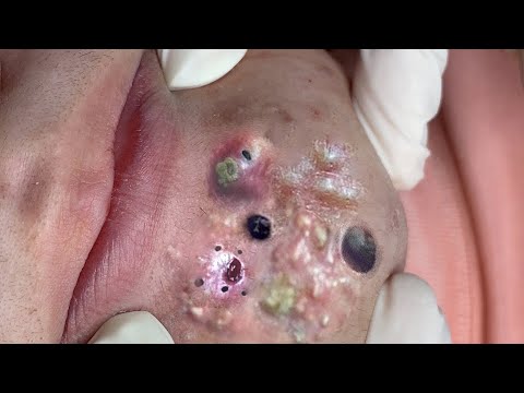 SATISFYING AND RELAXING PIMPLE POP COMPILATION | PART 29