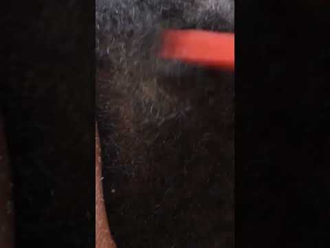 Scratching dandruff on the scalp. #asmr #satisfying #dandruff