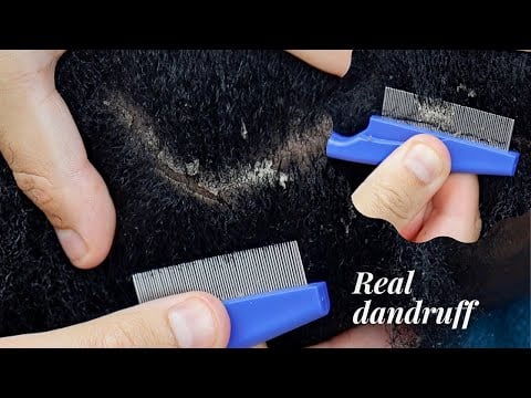 ASMR Real DANDRUFF 🤯 | Allzoomed Scratching, Parting Triggers For Sleep | video on Malaika Asmr