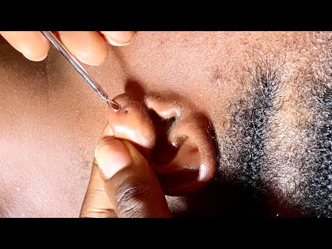 ✨ASMR ✨A RARE EAR HOLE NITPICKING-SOFT WHISPERS, GUM CRACKING