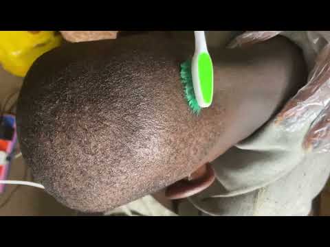 DANDRUFF REMOVAL ASMR/ SATISFYING DANDRUFF SCRATCHING ON SCALP -INTENSE SOUND #dandruff