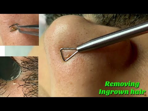 ASMR Removing Ingrown Hair & Whiteheads from face. SUPER ZOOM (not clickbait)