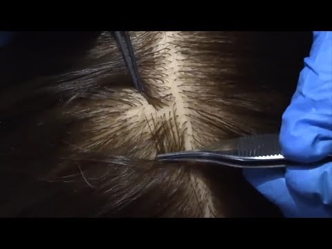 ASMR Scalp Check and Treatment (Tweezers, Scalp Massage, Close Up, Whispering) Medical Roleplay