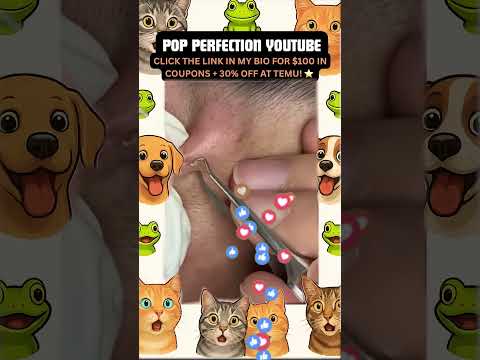 Wow! #pimpleremoval #pimple #pimples #shortsfeed #shortvideo #shorts #short #youtube #youtubeshorts