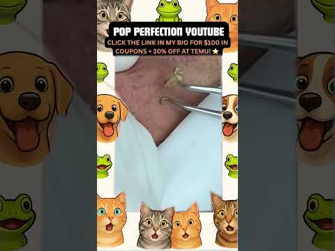 Wow! #pimpleremoval #pimple #pimples #shortsfeed #shortvideo #shorts #short #youtube #youtubeshorts