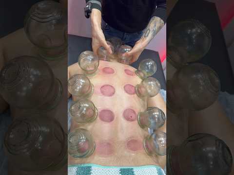 "ASMR" Cupping Alinezhad#shorts #cupping #cuppingtherapy #youtubeshorts #massage #asmr #explore