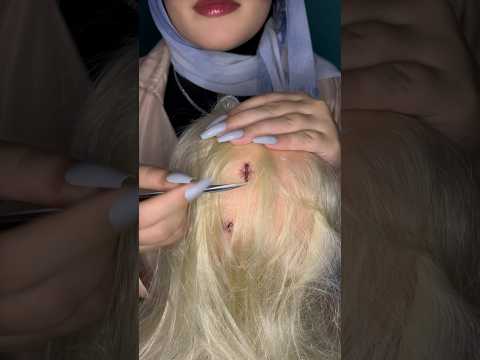 lice & bugs plucking 🐜🔍 #asmr #satisfying #visualtingle #asmrmassage #tingles #shorts