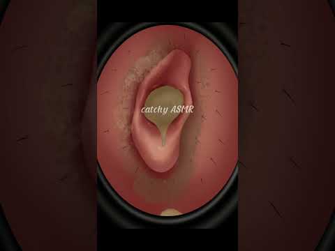 Hard Ear Wax Removal ASMR Animation, Relaxing Ear wax removal Animation, Satisfying ASMR Animation