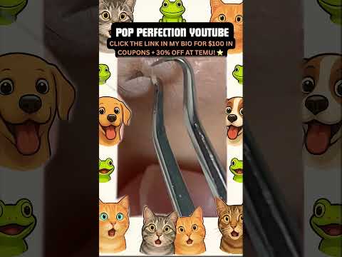 Wow! #pimpleremoval #pimple #pimples #shortsfeed #shortvideo #shorts #short #youtube #youtubeshorts