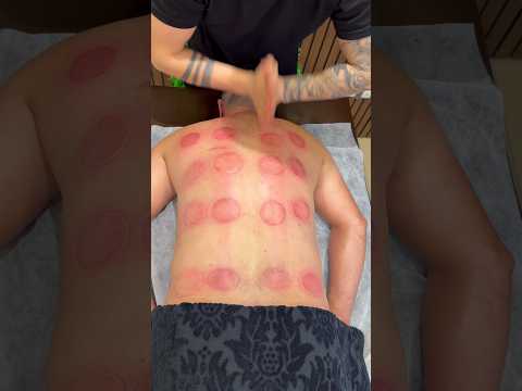 Vip Cupping 😍❤️#asmr #cupping #relax #shorts #massage #explore #fyp #viral #fire #cuppingtherapy