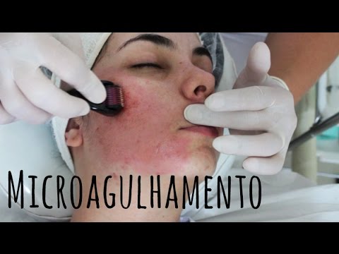 2ª SESSÃO DO MICROAGULHAMENTO -  ADEUS CICATRIZES DE ACNE! ~Sweet Carol