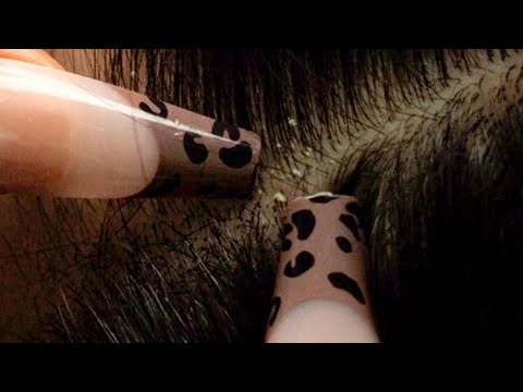 ASMR | Attentive Nitpicking Whiteheads | Intense Scalp Scratching {soft whispers 😴}