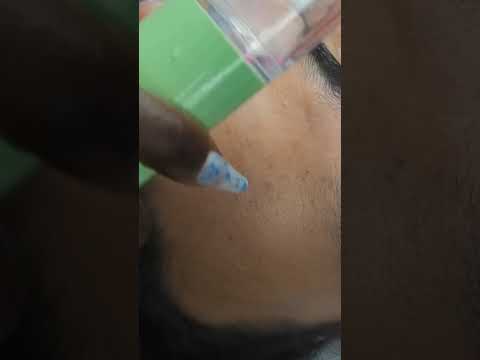 LOOK, PIMPLES coming out of his skin! #asmr #shorts  #youtubeshorts #shortsvideo