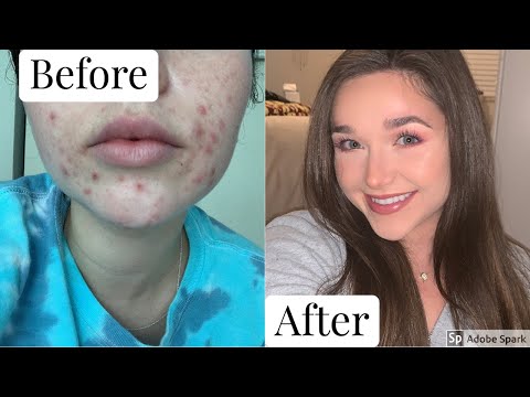 ASMR - How I Cleared My Acne