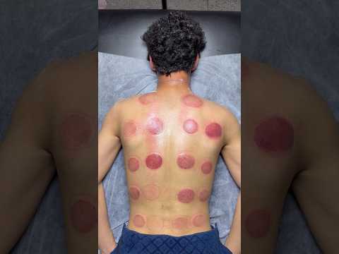 "ASMR" vip cupping 😍#shorts #asmr #youtubeshorts #cuppingtherapy #viral