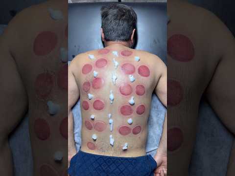 wow ASMR Vip Cupping😍🔥#cupping #asmr #shorts #trending