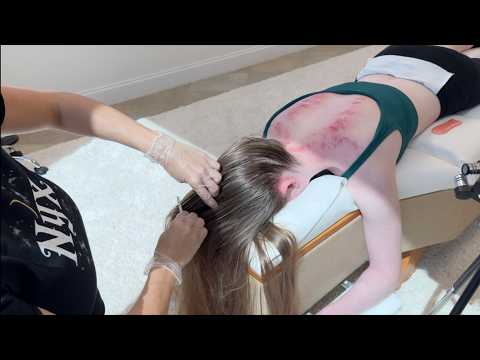 Scraping Out Spinal Nerves Through the Skin for Relief