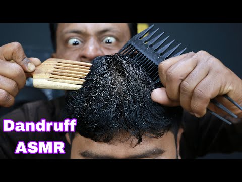 Huge Dandruff Scratching ASMR | ASMR Dandruff Treatment | ASMR Dandruff Removal | Neck Cracking ASMR
