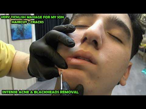 I REMOVAL MY SON'S TEENAGE ACNE & BLACKHEADS + HAIRCUT + CRACKS + ASMR Head, Face, Ear, Neck Massage