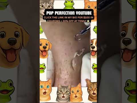 Wow! #pimpleremoval #pimple #pimples #shortsfeed #shortvideo #shorts #short #youtube #youtubeshorts
