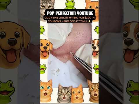 Wow! #pimpleremoval #pimple #pimples #shortsfeed #shortvideo #shorts #short #youtube #youtubeshorts