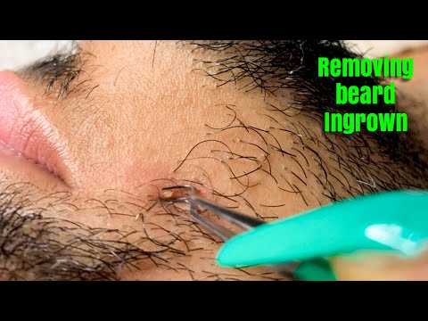 ASMR Upclose Zoom Removing ingrown hair from beard & moustache