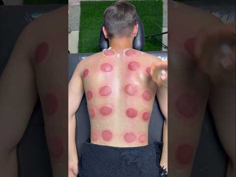 vip cupping😍#cupping #asmr #explore #shorts #viral