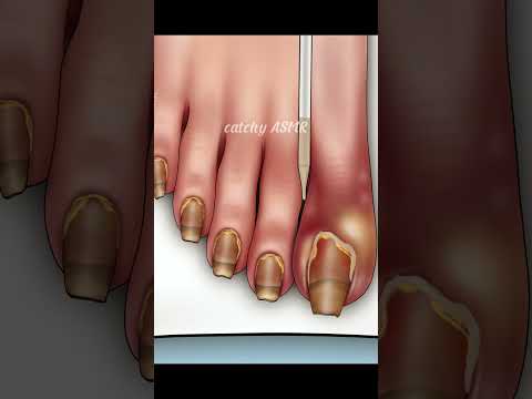 That relief after removing an ingrown nail, Animated ASMR treatment ,  ASMR animation