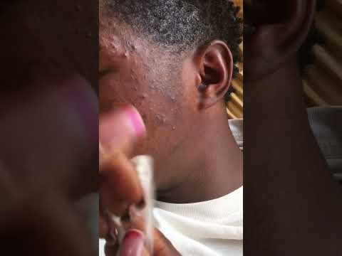 Ear nitpicking and cleaning #blackheads #satisfying #asmrsounds #relaxing #earcleaning