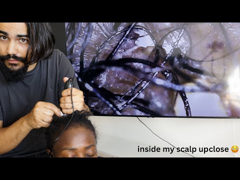 ASMR | Scalp Under A microscope 100x zoom | what we found inside the scalp.