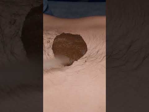 ASMR: Massaggio Cinese allo Stomaco con Moxibustione! #shorts