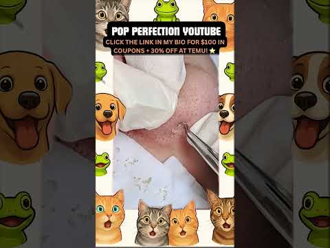 Wow! #pimpleremoval #pimple #pimples #shortsfeed #shortvideo #shorts #short #youtube #youtubeshorts