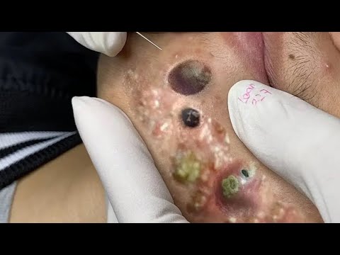 SATISFYING AND RELAXING PIMPLE POP COMPILATION | PART 21