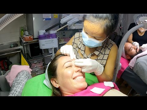 Retiro extremo de puntos negros 😱 *Increíble extracción masiva* 🤢