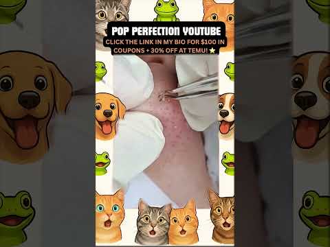 Wow! #pimpleremoval #pimple #pimples #shortsfeed #shortvideo #shorts #short #youtube #youtubeshorts