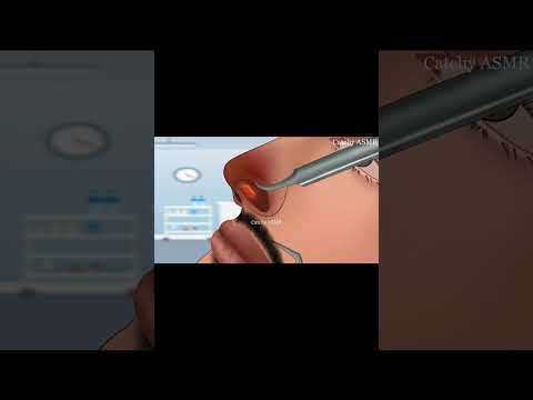 nose piercing ASMR animation|| piercing pus removal animation|| #animation #2d  #treatmentanimation