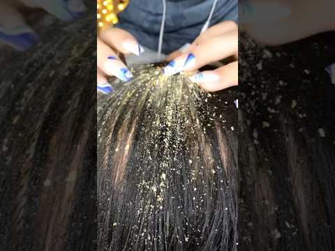 Dandruff Removal 💆🏻‍♀️😴 #asmr #satisfying #visualtingle #tingles #relaxing #relax #hair #shorts