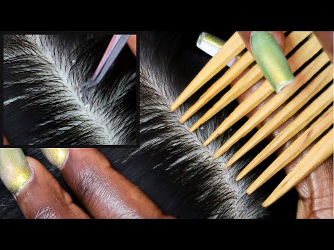 ASMR | Allzoomed Nitpicking & Scratching Scalp Whiteheads With Tweezers