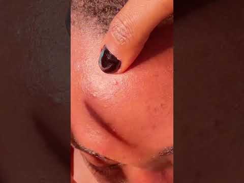 Asmr Face Nitpicking, Personal Attention #asmr #satisfying #relaxing #tingling