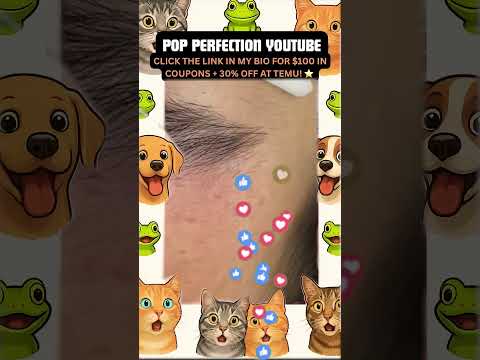 Wow! #pimpleremoval #pimple #pimples #shortsfeed #shortvideo #shorts #short #youtube #youtubeshorts