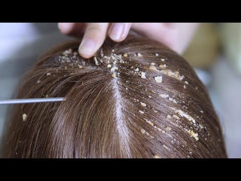 Dandruff Removal with Herbal Materials  | Satisfying ASMR