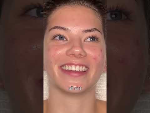 Satisfying Pore Extraction Tutorial: Clear Your Skin! #shorts