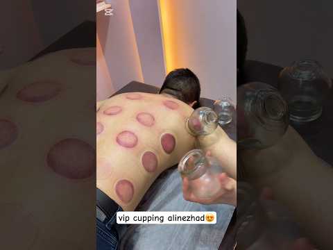 vip cupping😍#asmr #shorts #cupping #massage #fyp #pizza  #youtubeshorts