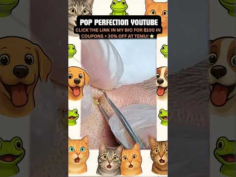Wow! #pimpleremoval #pimple #pimples #shortsfeed #shortvideo #shorts #short #youtube #youtubeshorts