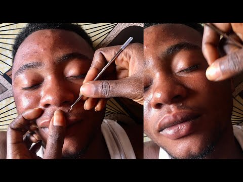 Asmr  Super Attentive picking And Cleaning-  a lot Of Whiteheads 😴